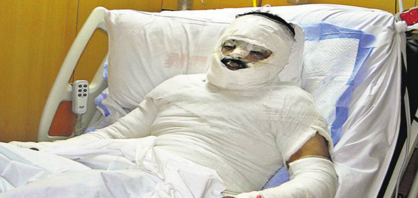 40-Year-Old Woman Throws Acid On 28-Year-Old Doctor Over Failed Relationship Acid attack