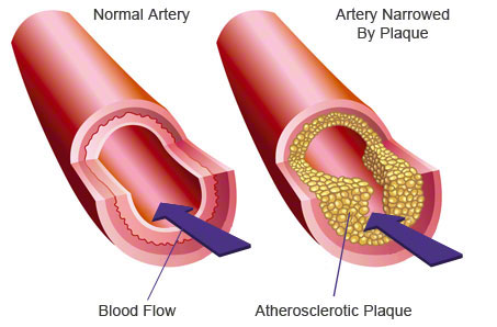 Arteries blocked because of smoking. 