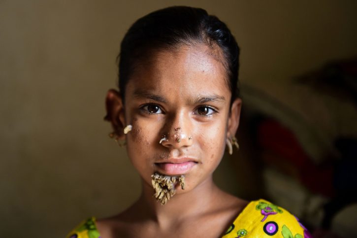 Bangladeshi Girl Becomes the First Female to have Tree Man Syndrome, first Female to have Tree Man Syndrome, Bangladeshi Girl to have Tree Man Syndrome, Tree Man disease, Epidermodysplasia Verruciformis,Tree Man Syndrome, girl suffering from Tree Man Syndrome, Tree Man Syndrome images, mango news, latest news, latest news updates
