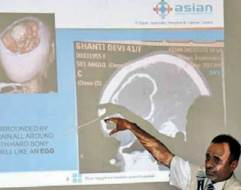 Asian Institute of Medical Sciences, Faridabad based, neurosurgeon, Dr. Kamal Verma, Echinococcus, large cyst