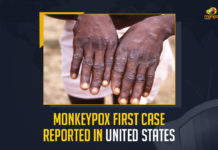Monkeypox First Case Reported In United States, Monkeypox First Case Reported In USA, US Massachusetts Department of Public Health confirmed a single case of monkeypox virus infection in an adult male with recent travel to Canada, US Massachusetts Department of Public Health, Commonwealth of Massachusetts said in a press release, US Centers for Disease Control and Prevention, Monkeypox First Case, Monkeypox Case, United States, Monkeypox First Case News, Monkeypox First Case Latest News, Monkeypox First Case Latest Updates, Monkeypox First Case Live Updates, Mango News,