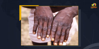 Monkeypox First Case Reported In United States, Monkeypox First Case Reported In USA, US Massachusetts Department of Public Health confirmed a single case of monkeypox virus infection in an adult male with recent travel to Canada, US Massachusetts Department of Public Health, Commonwealth of Massachusetts said in a press release, US Centers for Disease Control and Prevention, Monkeypox First Case, Monkeypox Case, United States, Monkeypox First Case News, Monkeypox First Case Latest News, Monkeypox First Case Latest Updates, Monkeypox First Case Live Updates, Mango News,
