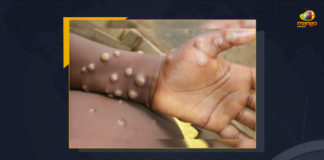 Monkeypox Spreads Across 19 Countries With Over 237 Cases, Monkeypox Spreads Across 19 Countries, 237 Cases Of Monkeypox In 19 Countries, outbreak of monkeypox cases outside of Africa can be contained, World Health Organization, 237 suspected and confirmed cases of the Monkeypox in 19 countries, Monkeypox is a usually mild viral infection that is endemic in parts of the west and central Africa, Monkeypox In 19 Countries, 19 Countries, Monkeypox News, Monkeypox Latest News, Monkeypox Latest Updates, Monkeypox Live Updates, Mango News,