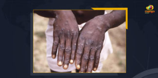 WHO Confirms Monkeypox Infection To Spread In 23 Countries So Far, WHO Warns Monkeypox Spreads in 23 Countries and Poses Moderate Risk To Public Health, Monkeypox Spreads in 23 Countries and Poses Moderate Risk To Public Health, WHO Warns Monkeypox Spreads in 23 Countries, Poses Moderate Risk To Public Health, Monkeypox confirmed in 23 nations, Poses moderate Risk, Monkeypox spreads to 23 countries, total 257 Monkeypox confirmed cases, World Health Organization, Public Health, World Health Organization Warns Monkeypox Spreads in 23 Countries, World Health Organization Warns 23 Countries, 23 Countries, Monkeypox News, Monkeypox Latest News, Monkeypox Latest Updates, Monkeypox Live Updates, Mango News,