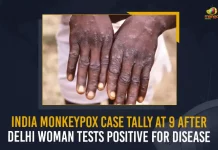 India Monkeypox Case Tally At 9 After Delhi Woman Tests Positive For Disease, Delhi Woman Tests Positive For Monkeypox Disease, Positive For Monkeypox Disease, Delhi Woman Tests Positive For Monkeypox, India Monkeypox Case Tally At 9, India Monkeypox Cases, Monkeypox Cases, Delhi Woman, Monkeypox cases are rising rapidly in India, Delhi reported its fourth case of Monkeypox, India Monkeypox Cases News, India Monkeypox Cases Latest News, India Monkeypox Cases Latest Updates, India Monkeypox Cases Live Updates, a 31-year-old woman tested positive for the Monkeypox disease, Mango News,