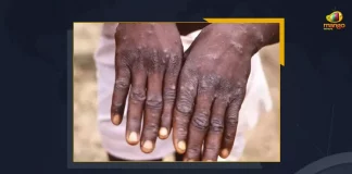 India Monkeypox Case Tally At 9 After Delhi Woman Tests Positive For Disease, Delhi Woman Tests Positive For Monkeypox Disease, Positive For Monkeypox Disease, Delhi Woman Tests Positive For Monkeypox, India Monkeypox Case Tally At 9, India Monkeypox Cases, Monkeypox Cases, Delhi Woman, Monkeypox cases are rising rapidly in India, Delhi reported its fourth case of Monkeypox, India Monkeypox Cases News, India Monkeypox Cases Latest News, India Monkeypox Cases Latest Updates, India Monkeypox Cases Live Updates, a 31-year-old woman tested positive for the Monkeypox disease, Mango News,
