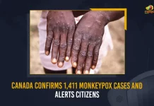Canada Confirms 1411 Monkeypox Cases And Alerts Citizens, Canada Confirms 1411 Monkeypox Cases, 1411 Monkeypox Cases In Canada, Monkeypox Outbreak In Canada, Mango News , Mango News Telugu, Public Health Agency of Canada,Canada Confirms Fourteen Monkeypox Cases, Monkeypox Cases In Canada , 2022 Monkeypox Outbreak Canada, 2022 Monkeypox Outbreak, Monkeypox Virus Canada, Monkeypox Outbreak Updates, Monkeypox Latest News And Updates, Monkeypox USA, Monkeypox Cases